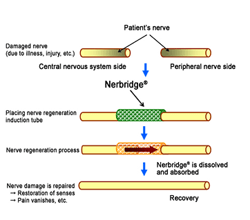 Process of treating damaged nerves with Nerbridge®